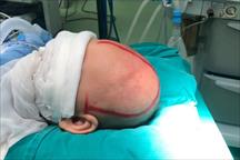 Phẫu thuật dị dạng hộp sọ bẩm sinh phức tạp cho bé 5 tháng tuổi